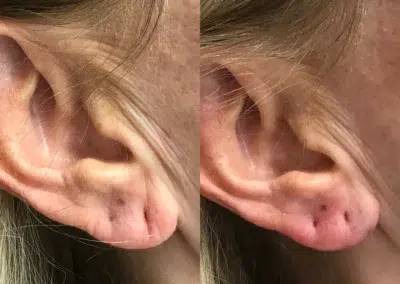 dermal filler before and after photo by bcrn aesthetics in houston tx