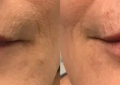 dermal filler before and after photo by bcrn aesthetics in houston tx