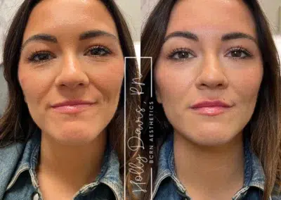 dermal filler before and after photo by bcrn aesthetics in houston tx