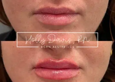dermal filler before and after photo by bcrn aesthetics in houston tx