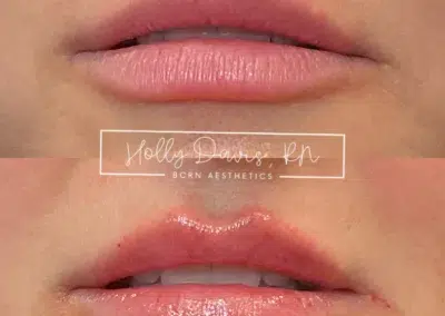 dermal filler before and after photo by bcrn aesthetics in houston tx