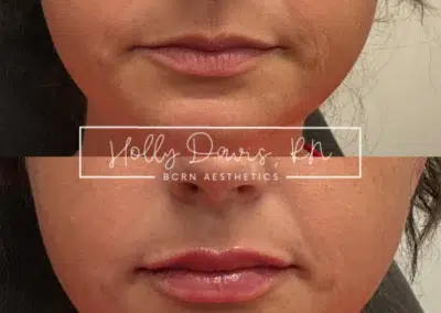 dermal filler before and after photo by bcrn aesthetics in houston tx