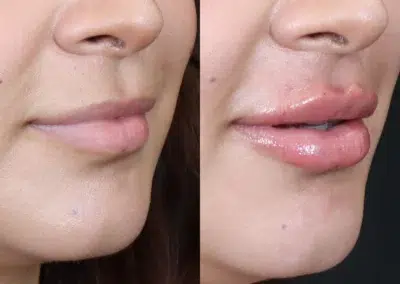 dermal filler before and after photo by bcrn aesthetics in houston tx