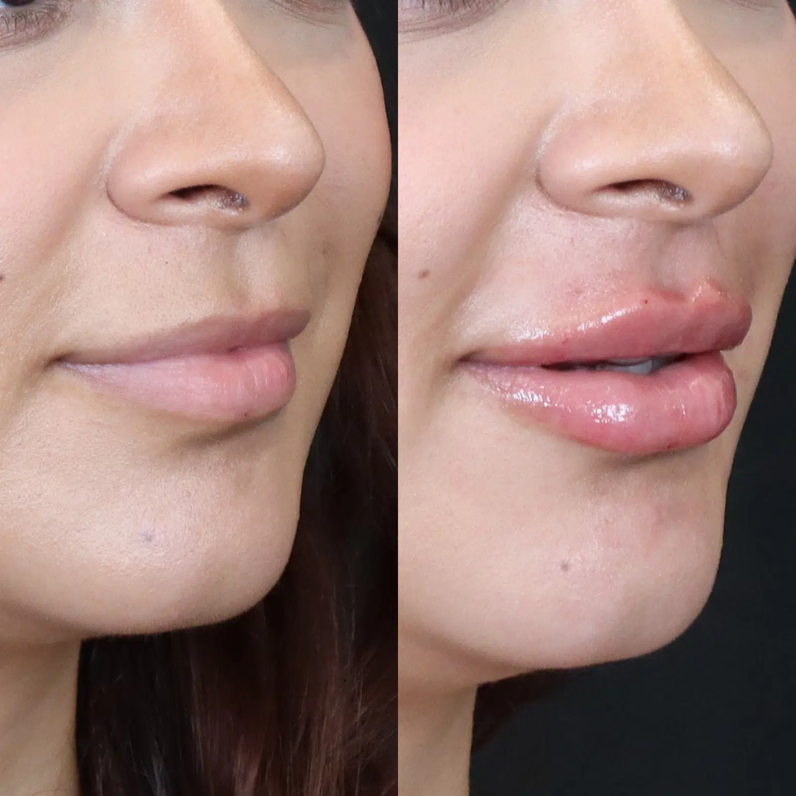 dermal filler before and after photo by bcrn aesthetics in houston tx dermal filler before and after photo by bcrn aesthetics in houston tx