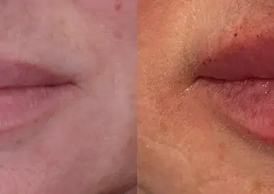 dermal filler before and after photo by bcrn aesthetics in houston tx