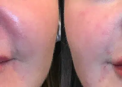 dermal filler before and after photo by bcrn aesthetics in houston tx