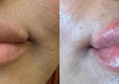 dermal filler before and after photo by bcrn aesthetics in houston tx