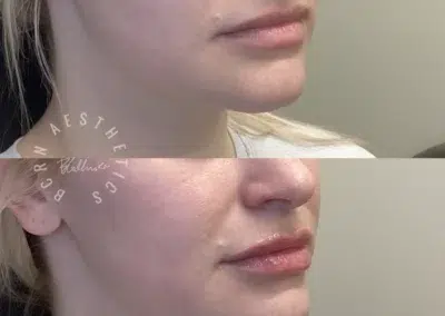 dermal filler before and after photo by bcrn aesthetics in houston tx