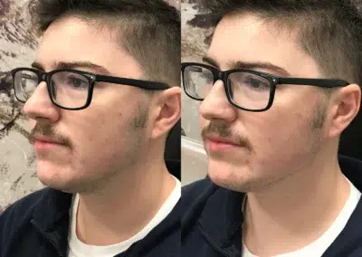 dermal filler before and after photo by bcrn aesthetics in houston tx