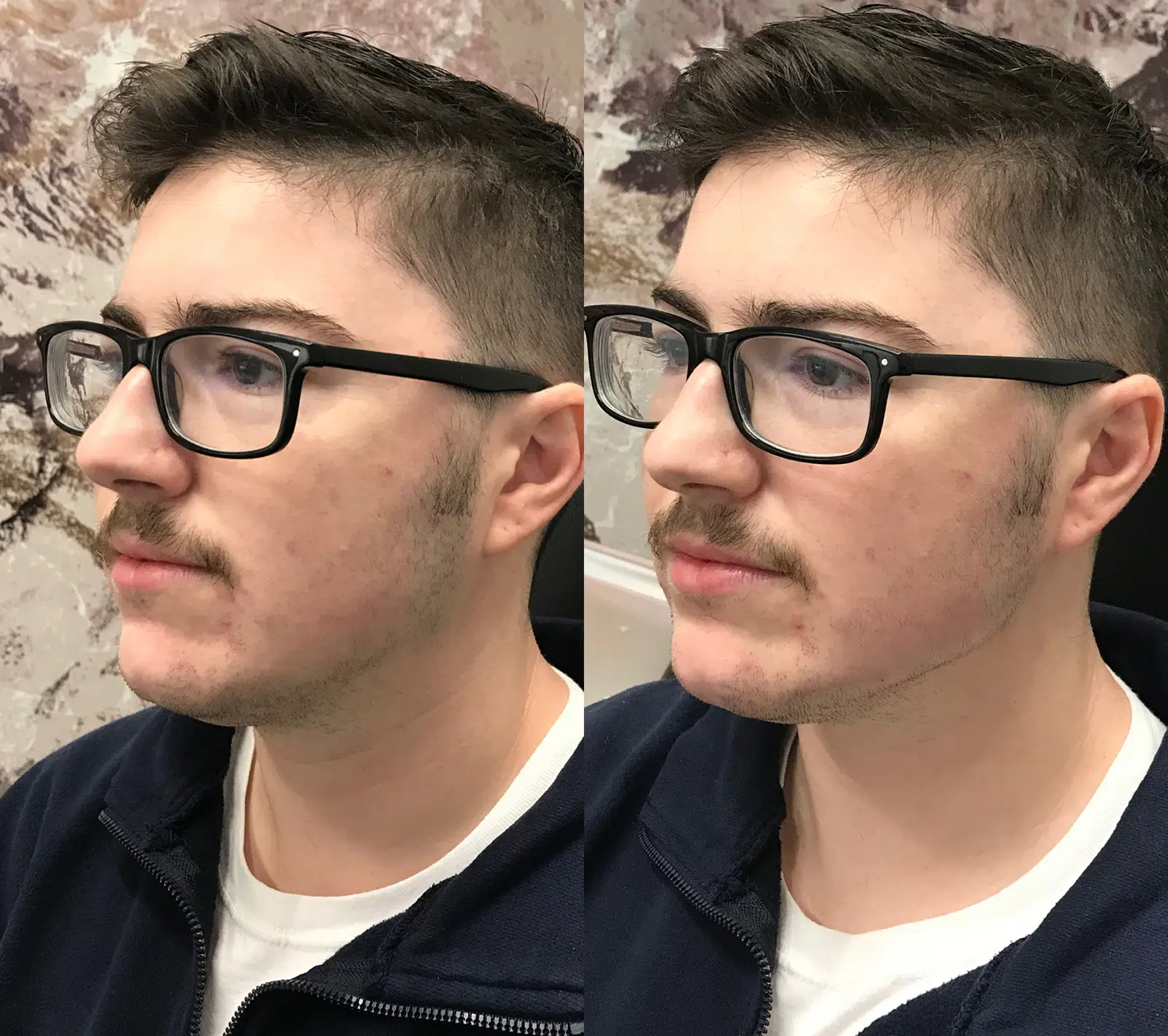 dermal filler before and after photo by bcrn aesthetics in houston tx dermal filler before and after photo by bcrn aesthetics in houston tx