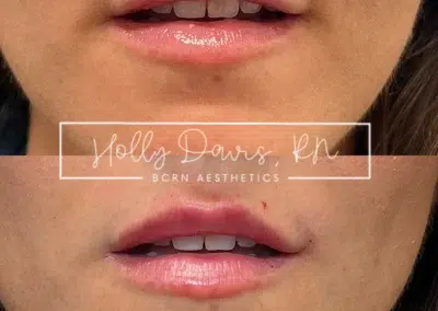 dermal filler before and after photo by bcrn aesthetics in houston tx