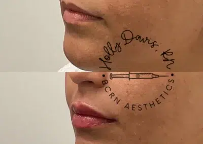dermal filler before and after photo by bcrn aesthetics in houston tx