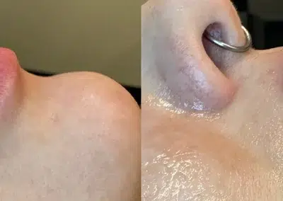 dermal filler before and after photo by bcrn aesthetics in houston tx