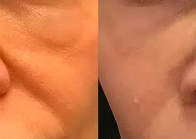 dermal filler before and after photo by bcrn aesthetics in houston tx