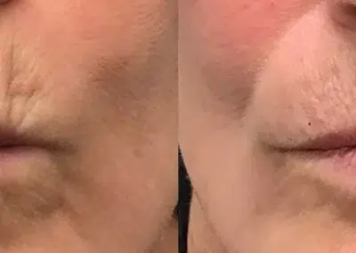 dermal filler before and after photo by bcrn aesthetics in houston tx