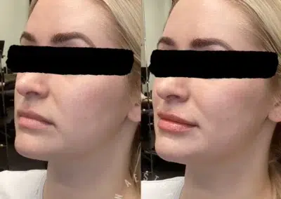 dermal filler before and after photo by bcrn aesthetics in houston tx