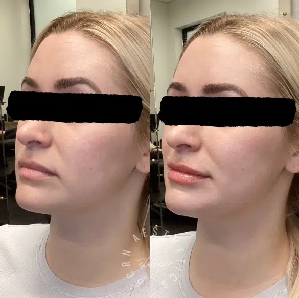 dermal filler before and after photo by bcrn aesthetics in houston tx dermal filler before and after photo by bcrn aesthetics in houston tx