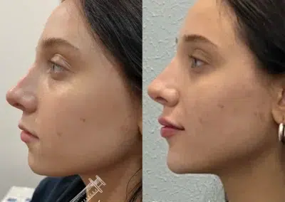 dermal filler before and after photo by bcrn aesthetics in houston tx