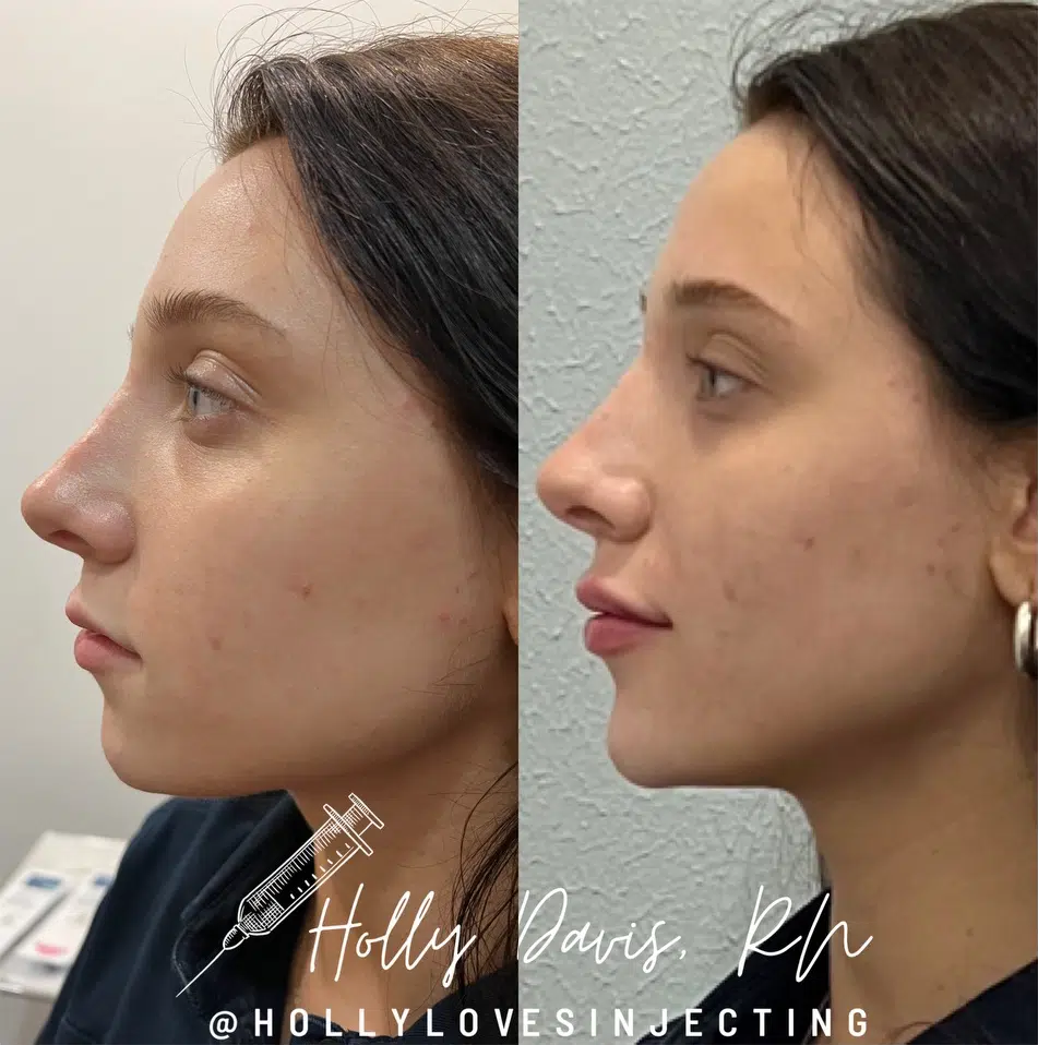 dermal filler before and after photo by bcrn aesthetics in houston tx dermal filler before and after photo by bcrn aesthetics in houston tx