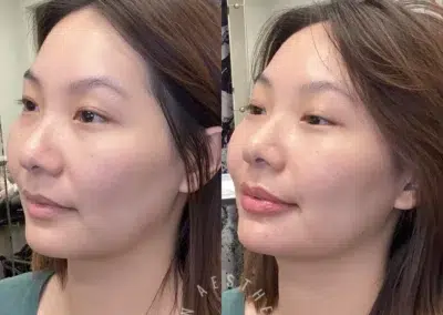 dermal filler before and after photo by bcrn aesthetics in houston tx
