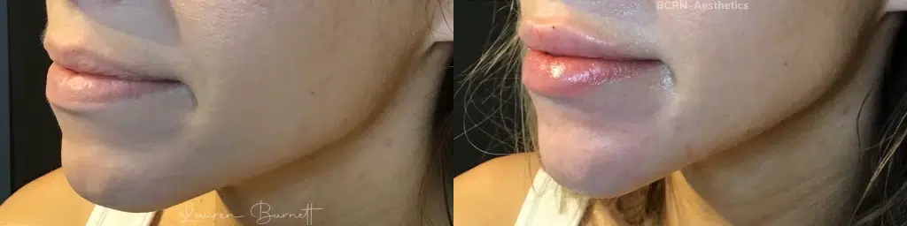 dermal filler before and after photo by bcrn aesthetics in houston tx
