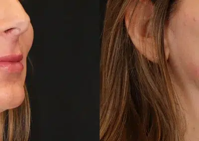 dermal filler before and after photo by bcrn aesthetics in houston tx