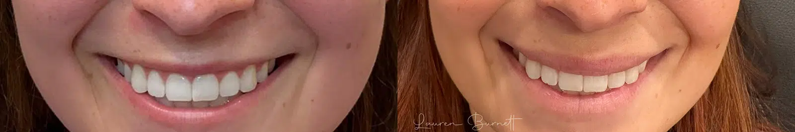 dermal filler before and after photo by bcrn aesthetics in houston tx