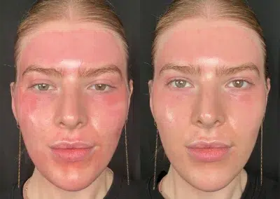 eltamd before and after photo by bcrn aesthetics in houston tx