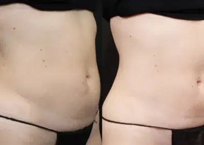 emsculpt neo before and after photo by bcrn aesthetics in houston tx