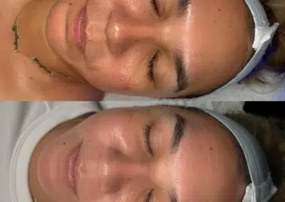 hydrafacial before and after photo by bcrn aesthetics in houston tx