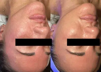 hydrafacial before and after photo by bcrn aesthetics in houston tx