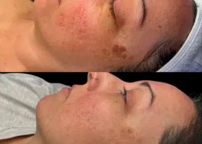 lumecca ipl before and after photo by bcrn aesthetics in houston tx