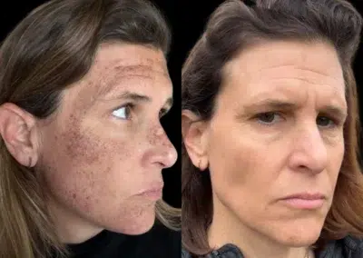 lumecca ipl before and after photo by bcrn aesthetics in houston tx