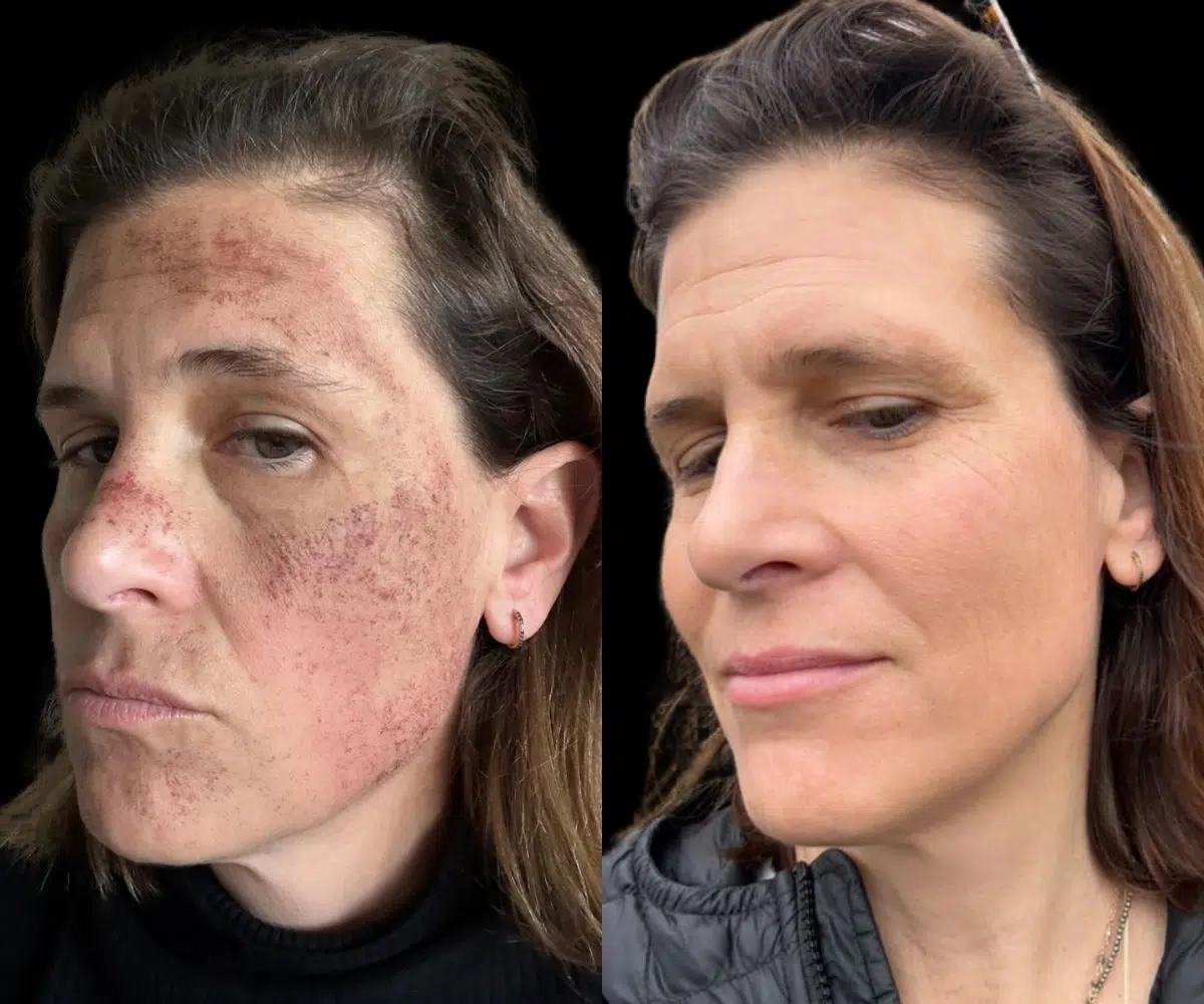 lumecca ipl before and after photo by bcrn aesthetics in houston tx lumecca ipl before and after photo by bcrn aesthetics in houston tx