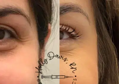 neuromodulators before and after photo by bcrn aesthetics in houston tx