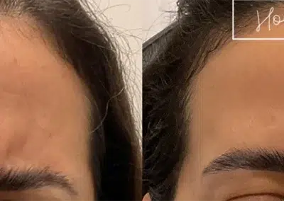 neuromodulators before and after photo by bcrn aesthetics in houston tx