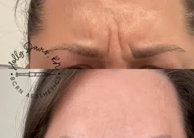 neuromodulators before and after photo by bcrn aesthetics in houston tx