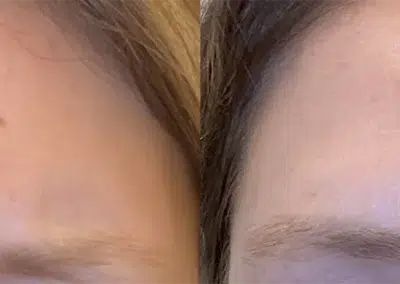 neuromodulators before and after photo by bcrn aesthetics in houston tx