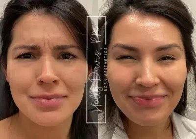 neuromodulators before and after photo by bcrn aesthetics in houston tx