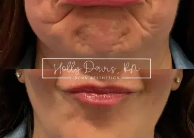 neuromodulators before and after photo by bcrn aesthetics in houston tx