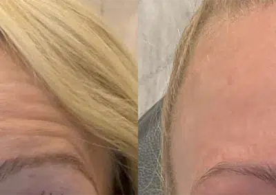 neuromodulators before and after photo by bcrn aesthetics in houston tx
