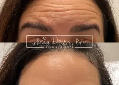 neuromodulators before and after photo by bcrn aesthetics in houston tx