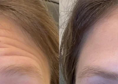 neuromodulators before and after photo by bcrn aesthetics in houston tx