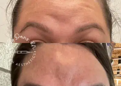 neuromodulators before and after photo by bcrn aesthetics in houston tx