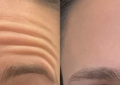 neuromodulators before and after photo by bcrn aesthetics in houston tx
