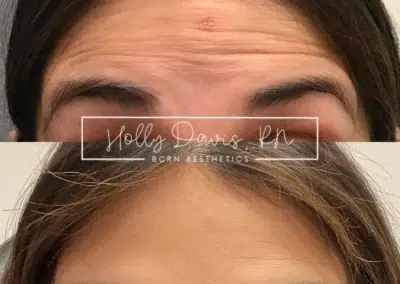neuromodulators before and after photo by bcrn aesthetics in houston tx