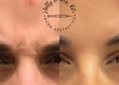 neuromodulators before and after photo by bcrn aesthetics in houston tx